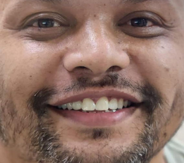 After Dental Bonding