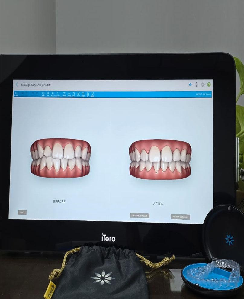 Invisalign corrects underbites and cross bite