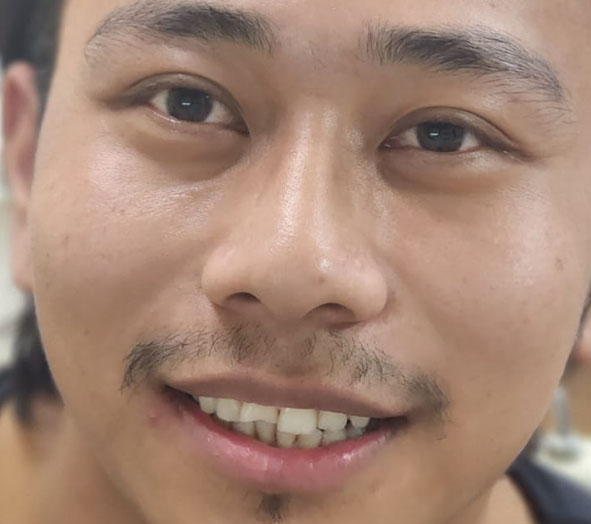 Before smile correction