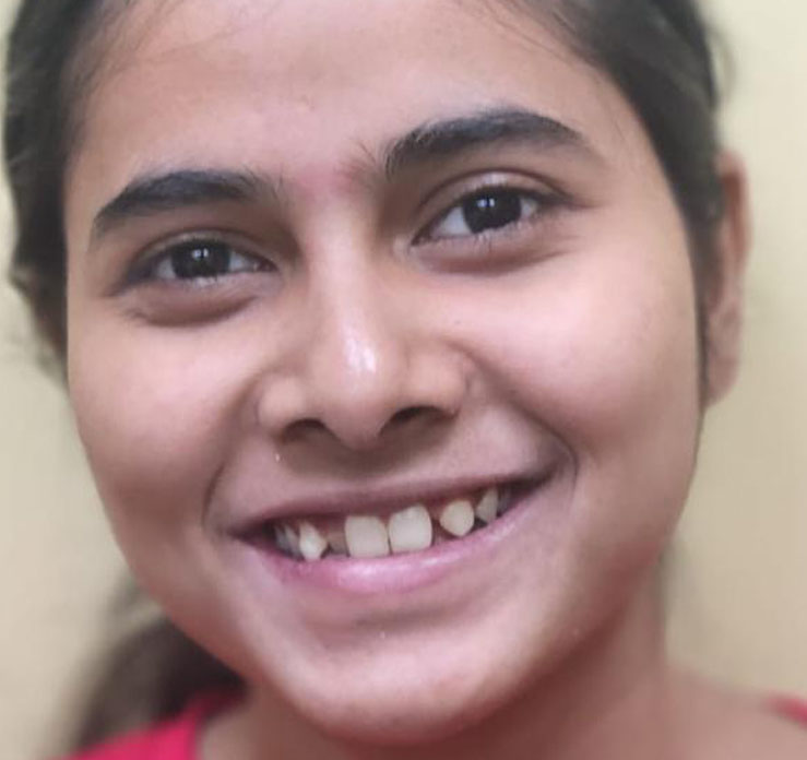 Gap and  teeth shape issue