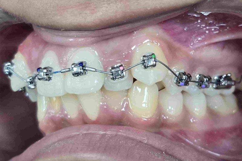 Braces by Orthodontist