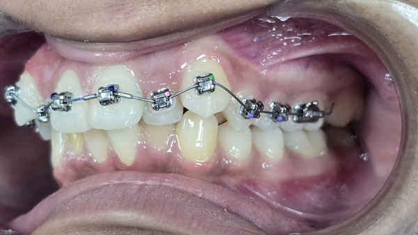 Metal braces