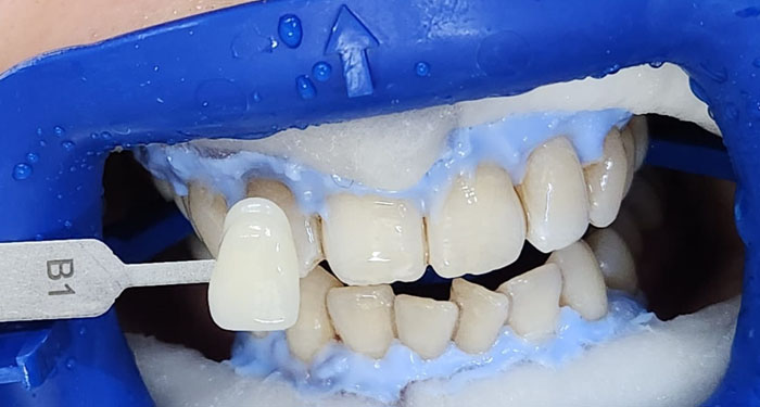 Brighter teeth after zoom