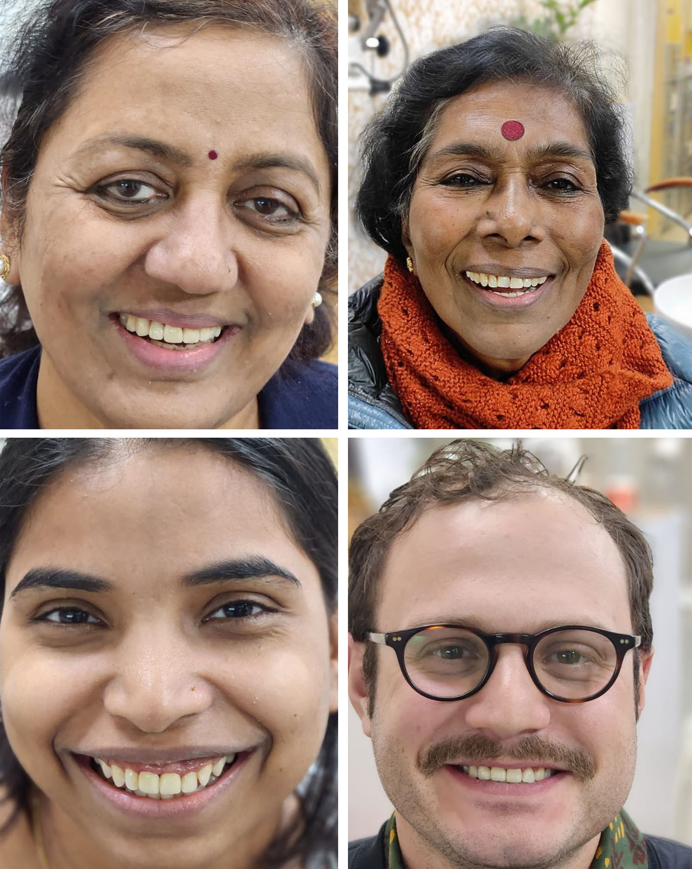 Same day tooth bridge in Delhi, Emaxtooth bridge in Delhi, Natural and low cost bridge, Smile with bridge