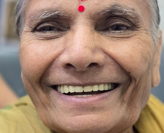 Combination of zygomatic, pterygoid and Conventional Implants