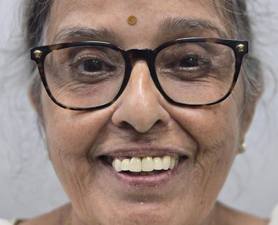 One Osstem implant with Ceramic crown