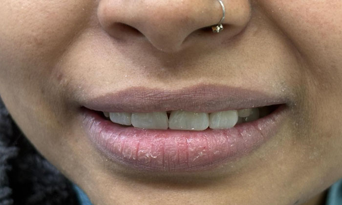 Veneers for front teeth gaps