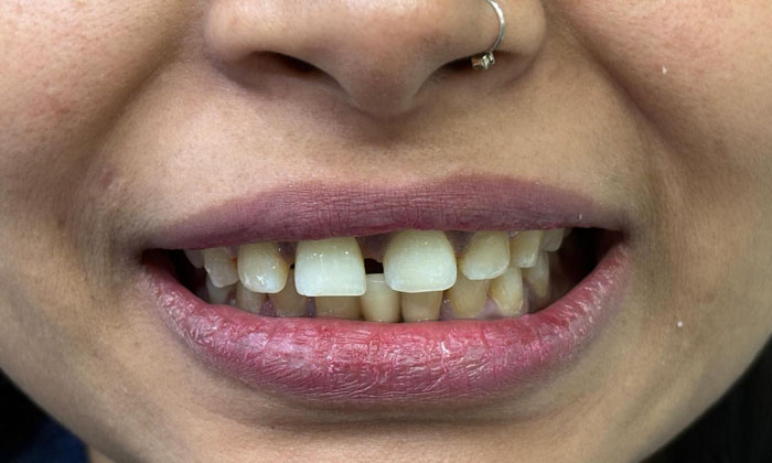 Front teeth gaps