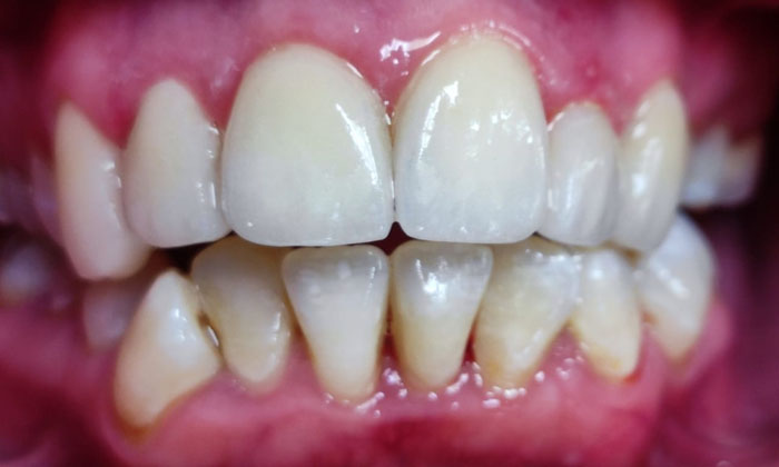 Veneers for discoloration