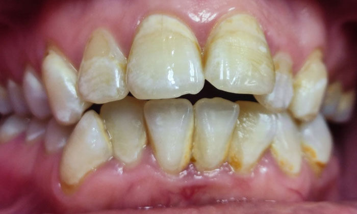 Front teeth discoloration