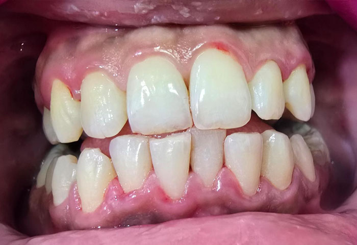 Clean teeth after GBT process