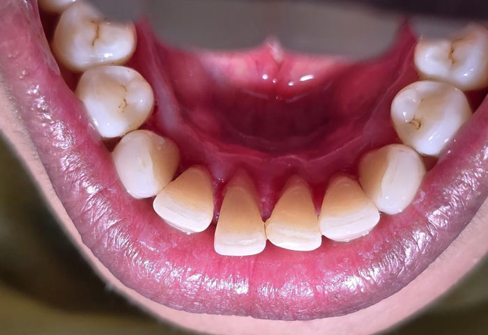 Complete cleaning with GBT