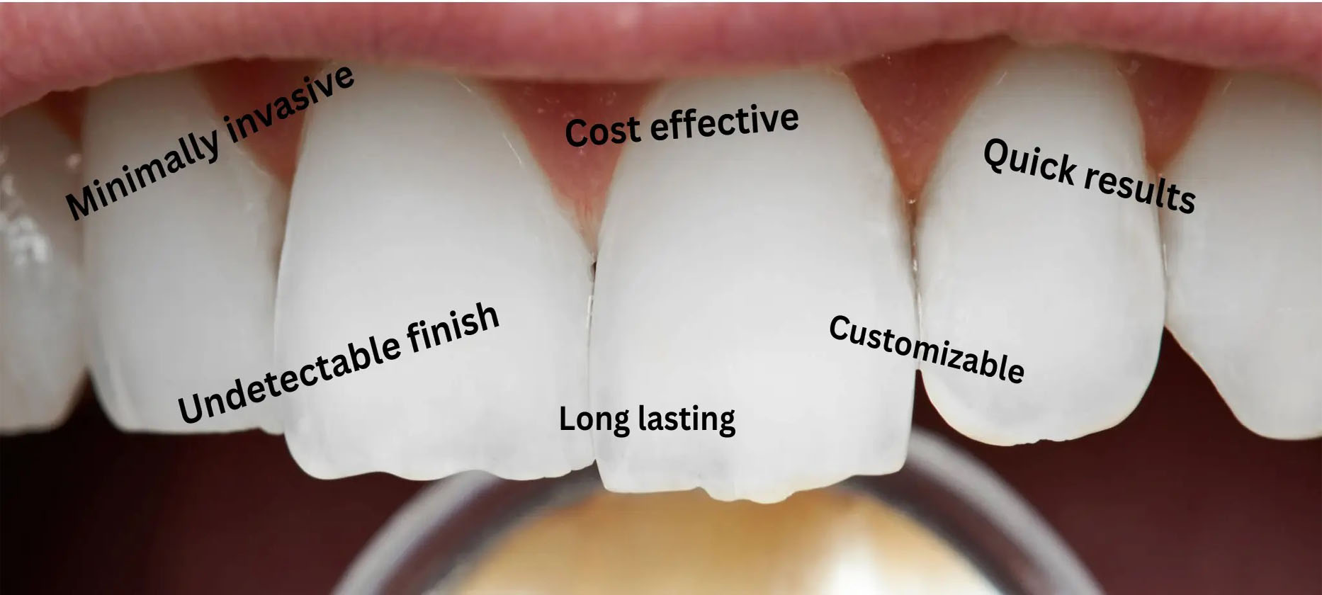 Low cost dental bonding