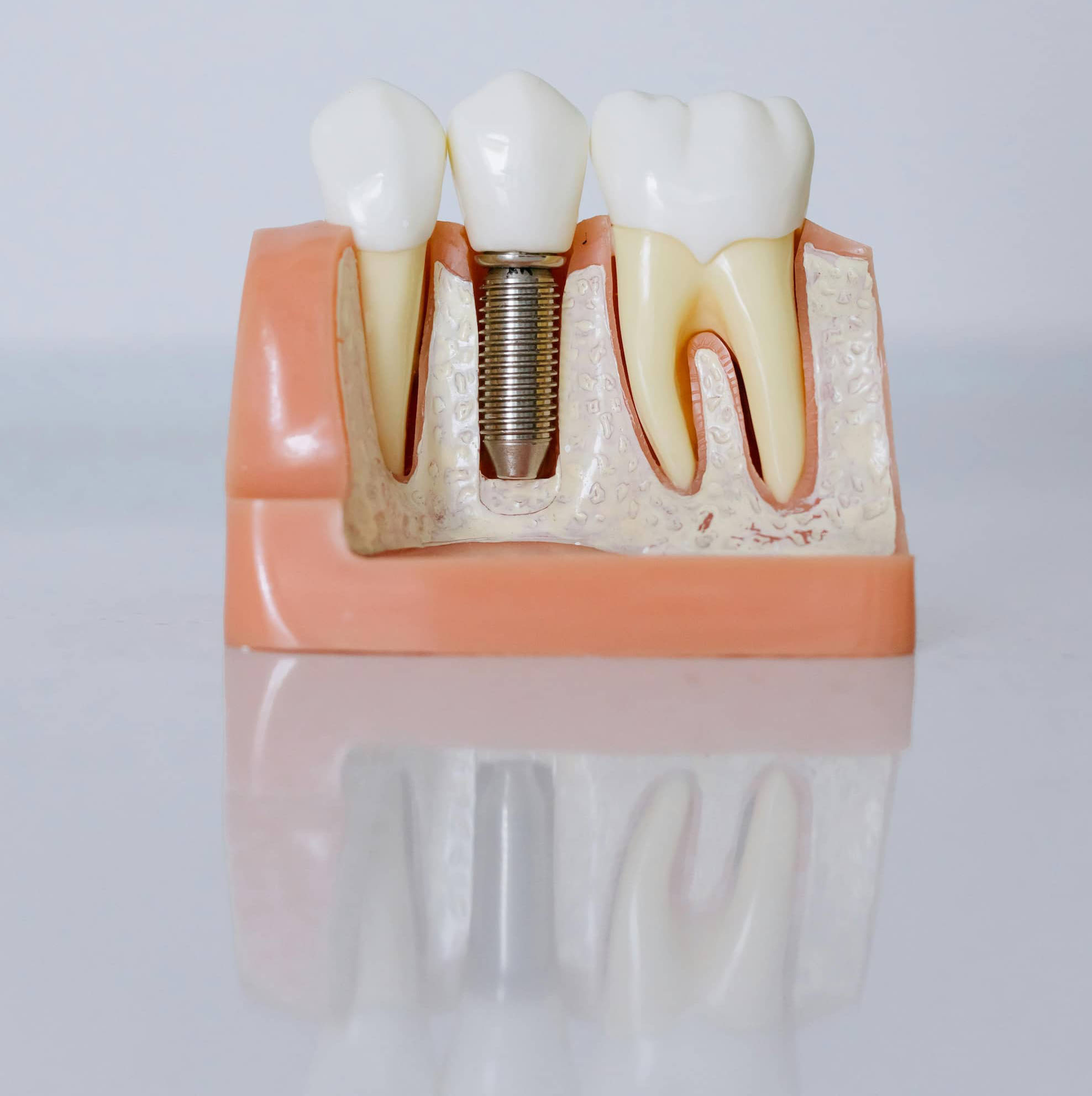 Dental Implant in Delhi