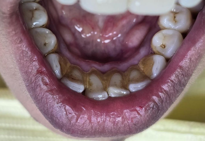 Deposits on back side of teeth