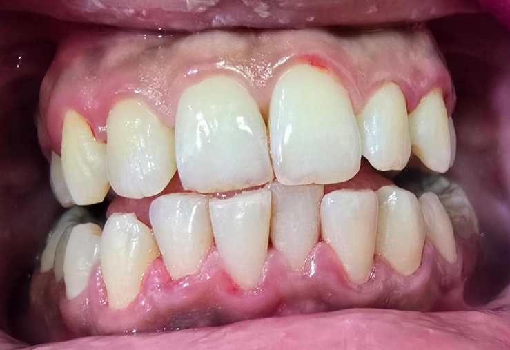 Sensitivity free Teeth Scaling