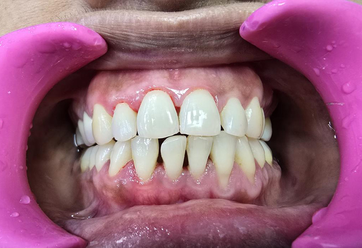 Pain free air teeth cleaning