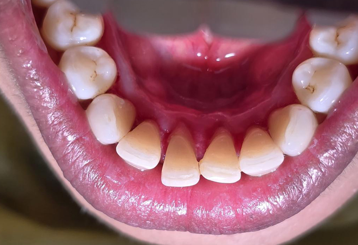 Gentle teeth cleaning with EMS