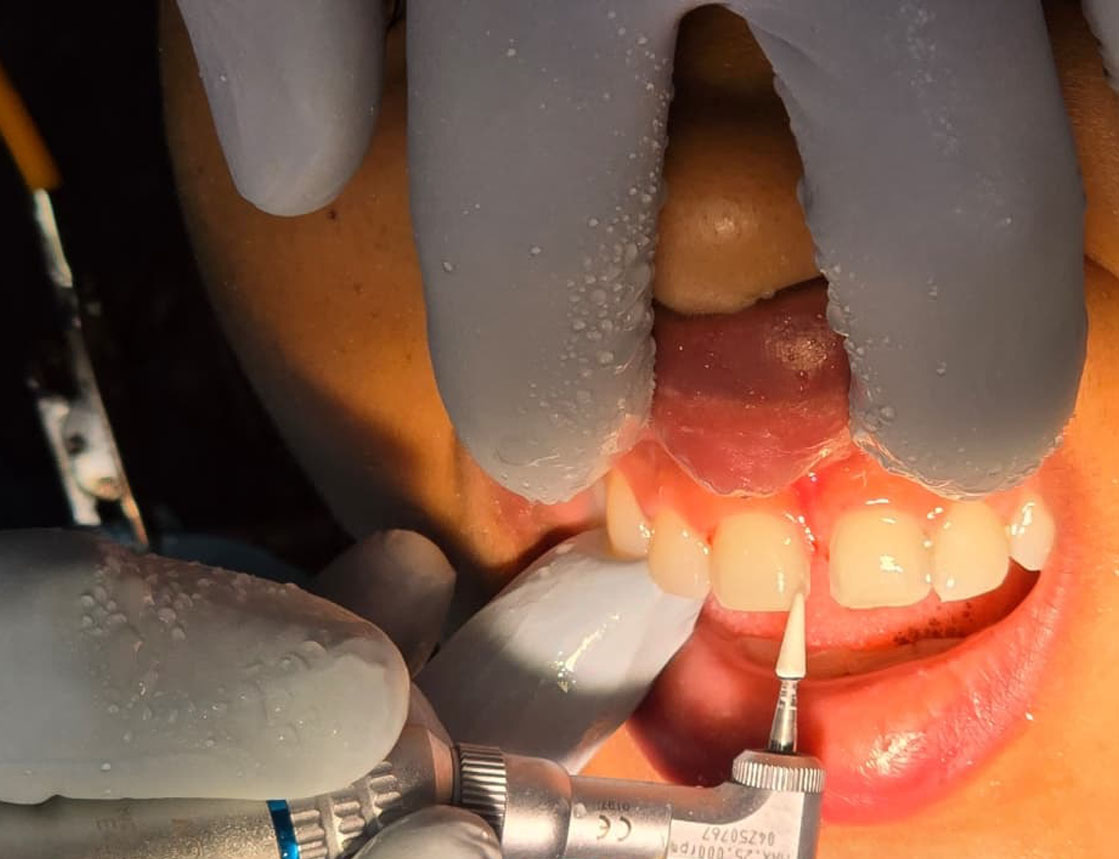 Smile correction with Bonding