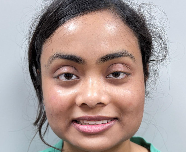 Gap correction with invisalign