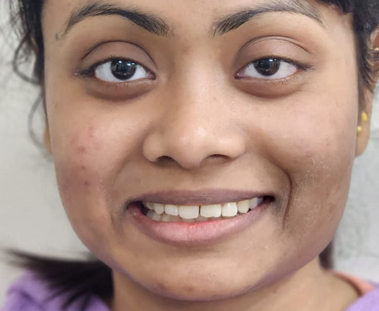 Generalized gaps in teeth