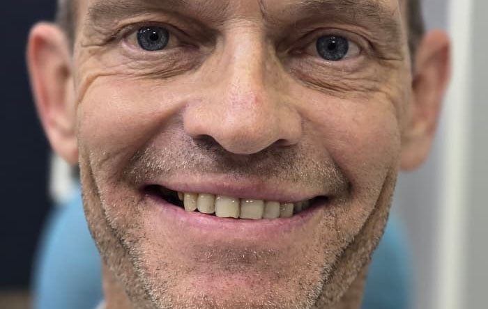 Implant with temporary crown