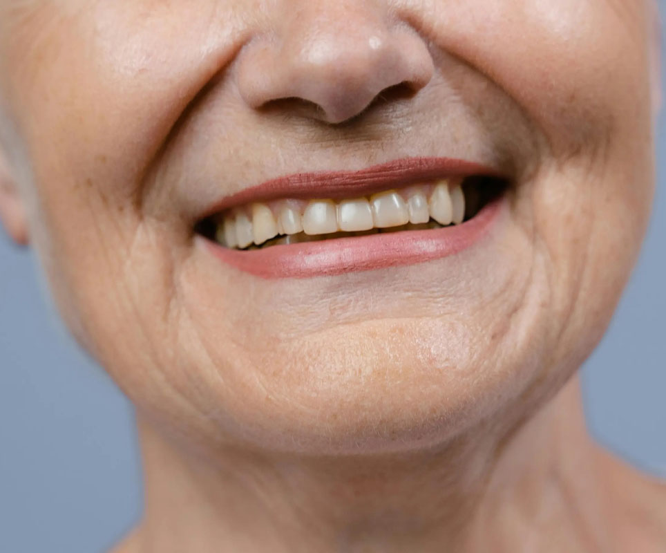 Smile correction with Bonding