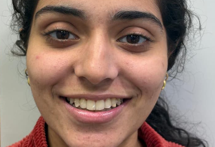 Protrusion corrected with Invisalign