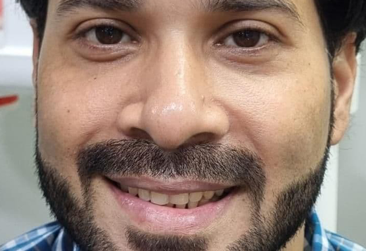 Invisalign for wide teeth gap