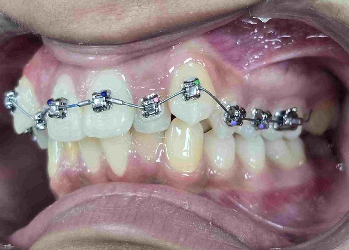 Low Cost Metal Braces