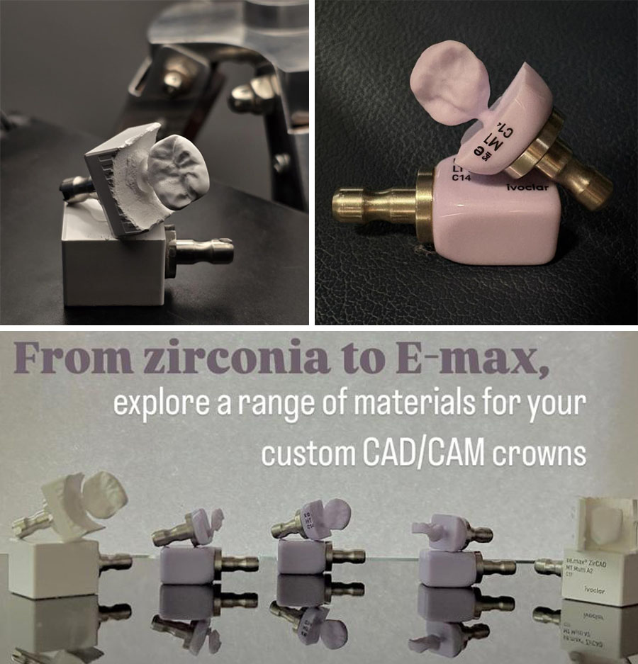 Metal free Smile with Porcelain & Zirconia Crowns