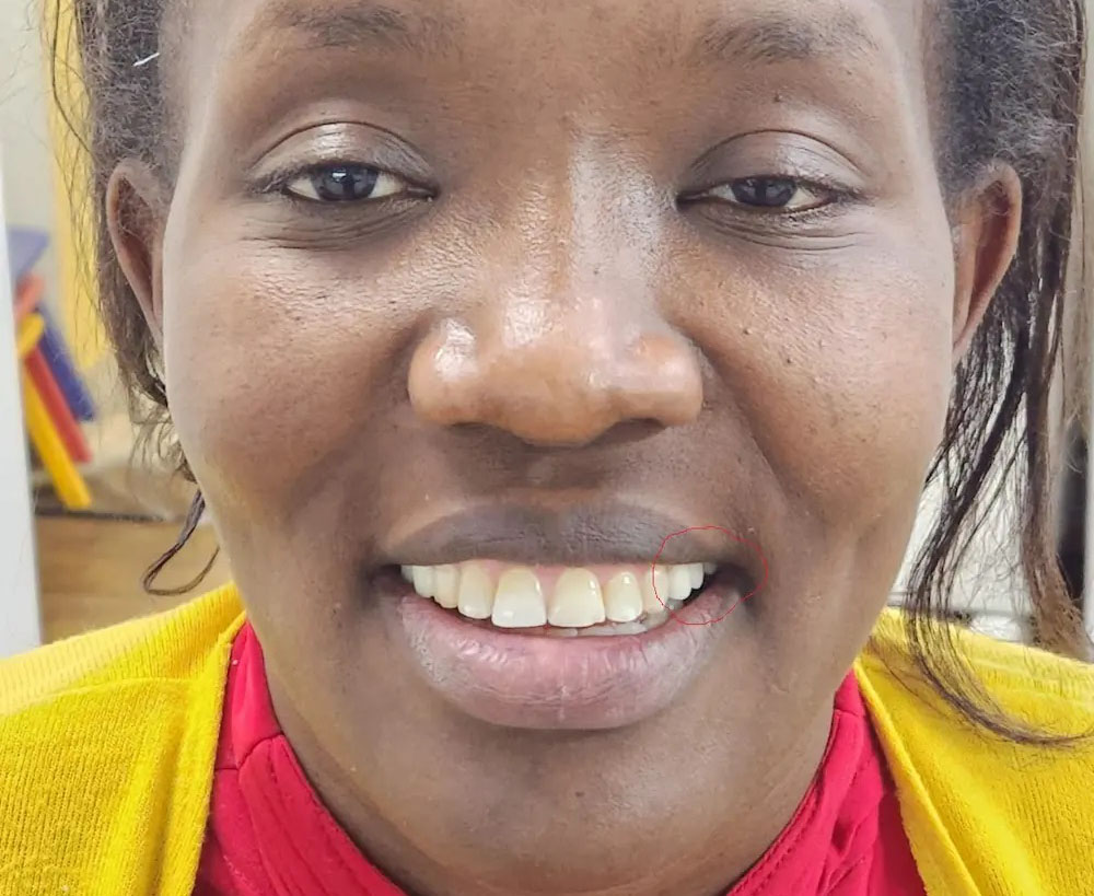 Happy patient after bridge