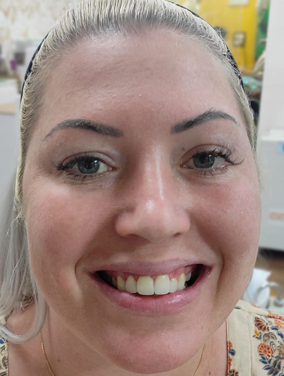 smile makeover with veneers