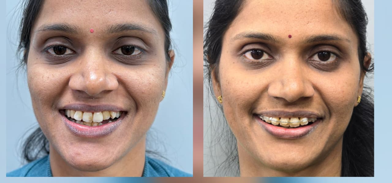 Teeth alignment with Braces in adults