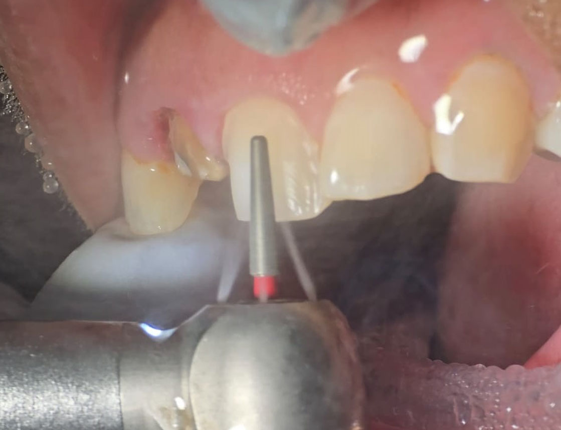 Minimal teeth reshaping