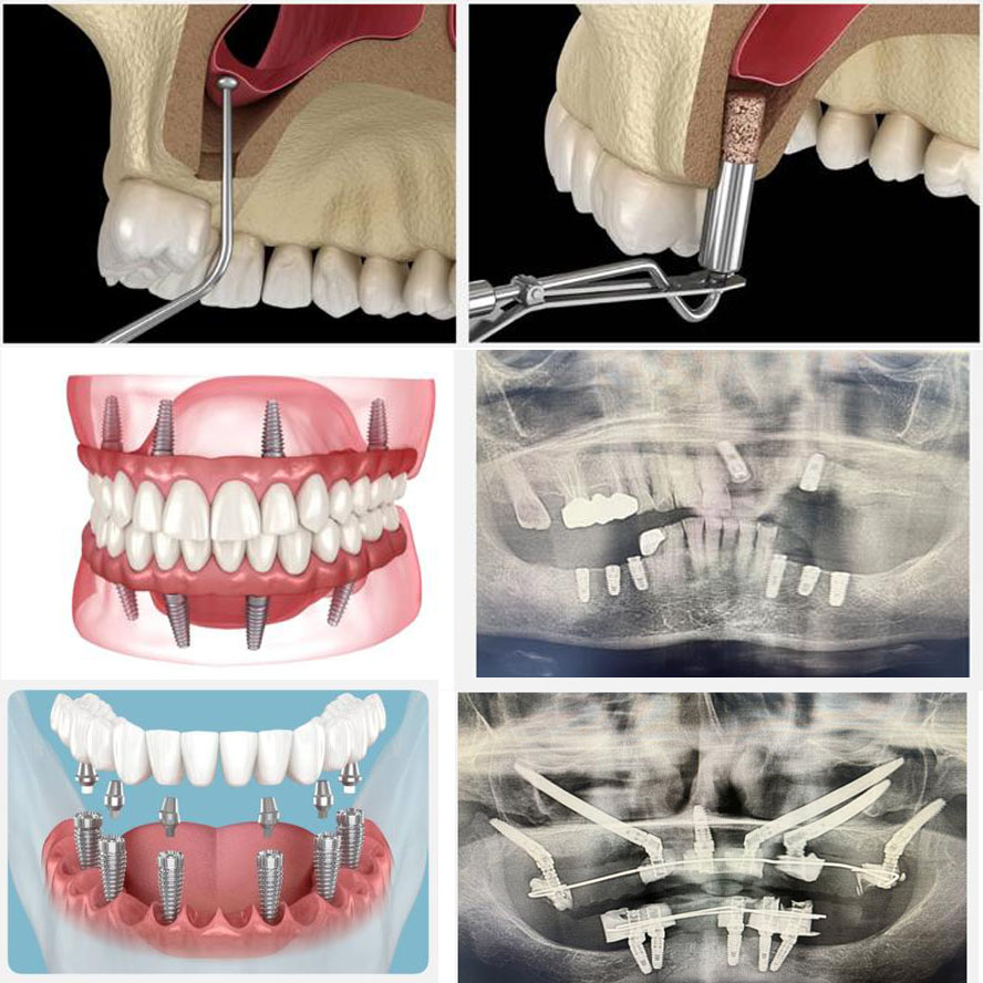 All on 4 Dental Implants