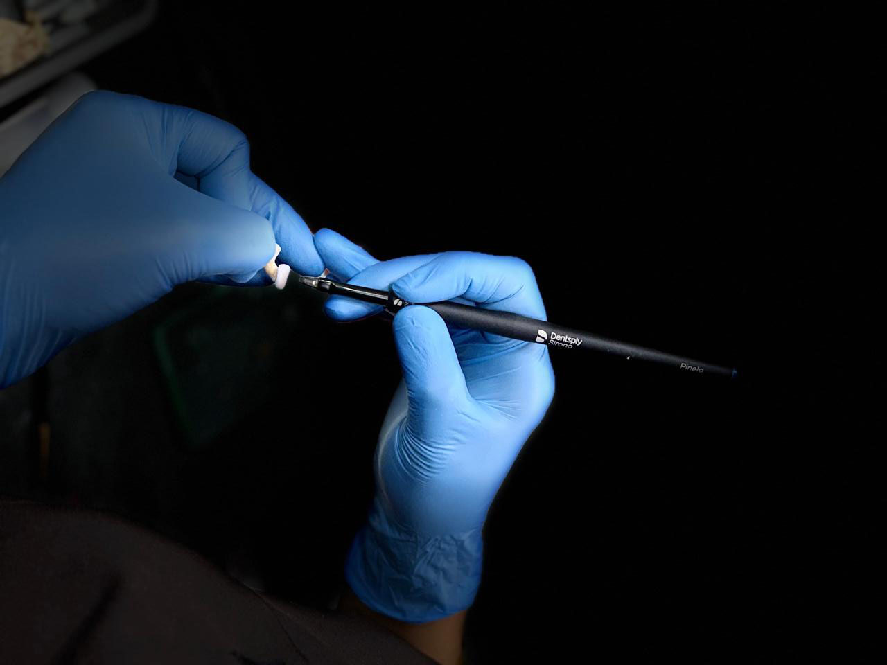 Goel Dental for Emax Veneer