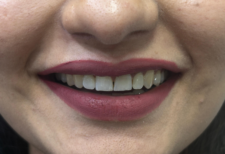 Front teeth Veneer