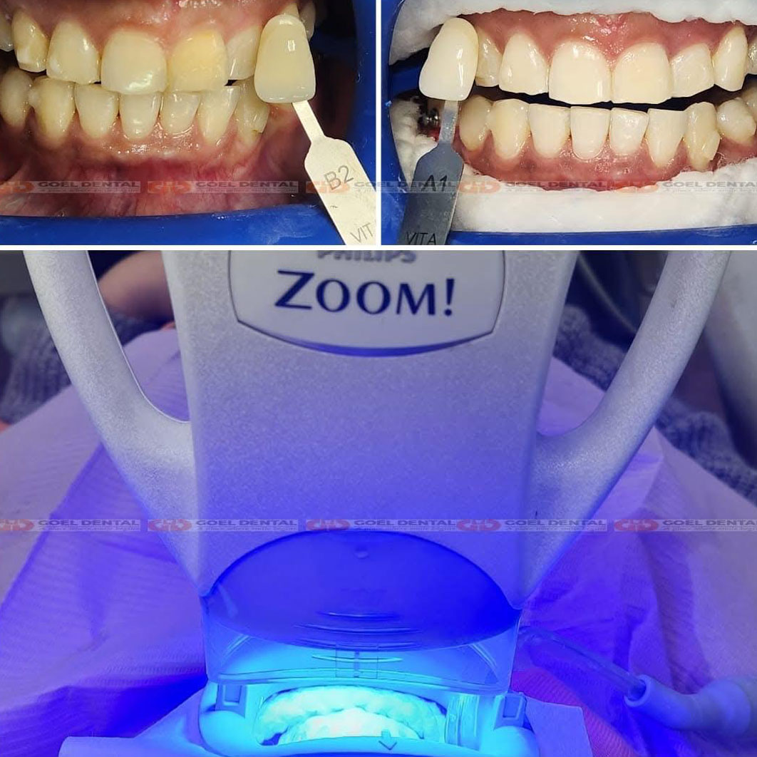 Philips Zoom Whitening in Delhi